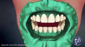 دندانپزشکی زیبایی  بلیچینگ | ک...