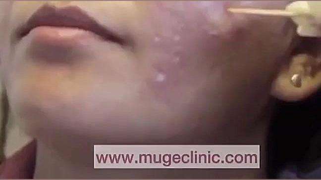 درمان جای جوش با TCA موگه کلین...