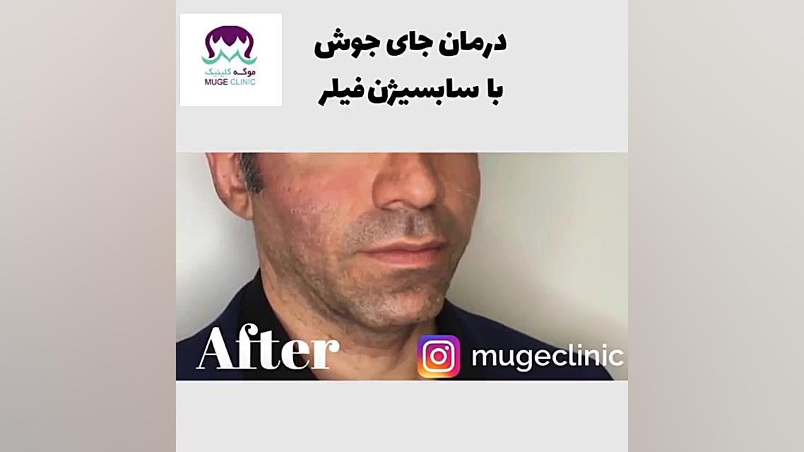 درمان اسکار اکنه با سابسیژن فی...