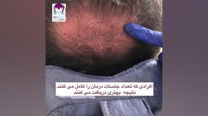 رضایت از انجام مزوتراپی مو موگ...