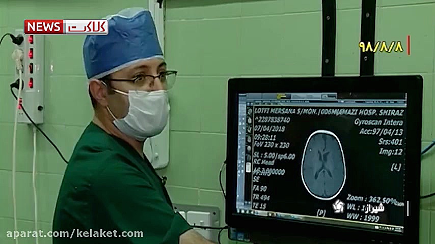 موفقیت نادرترین عمل جراحی مغز...