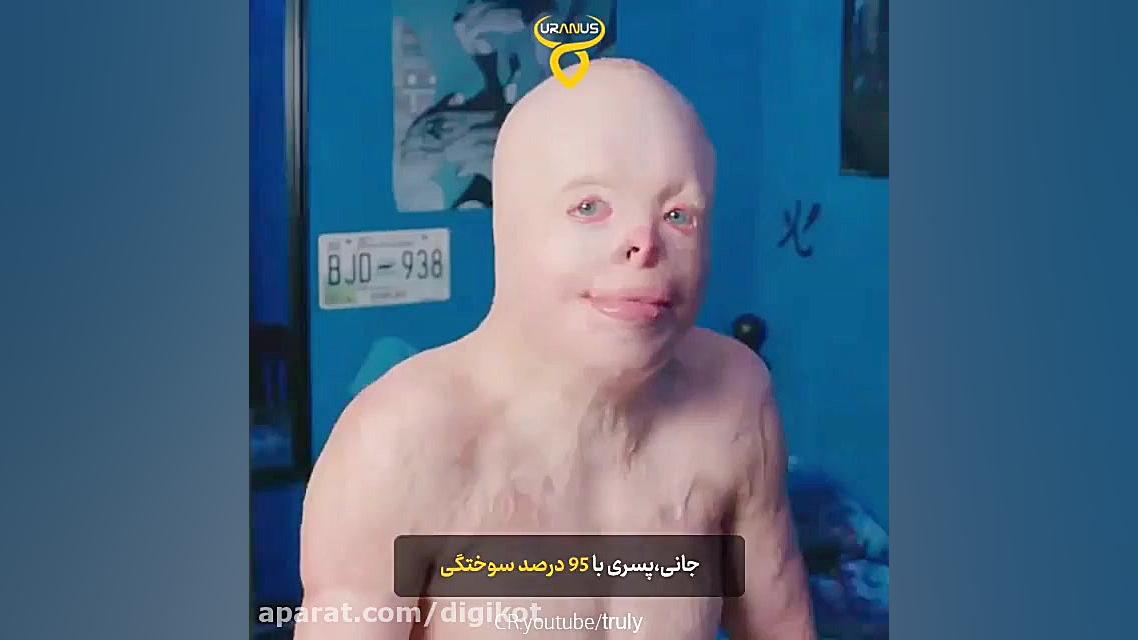 زندگی عجیب پسری با 95 درصد سوخ...