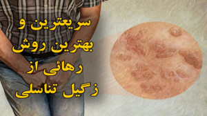 زگیل تناسلی ـ سریعترین و بهتری...