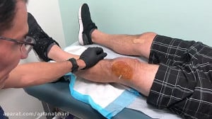 آموزش آمپول زدن به زانو (PRP)