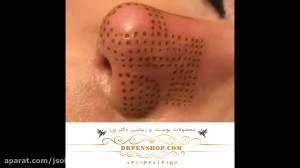 کوچک کردم بینی بدون عمل جراحی
