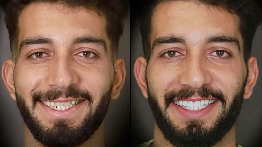 کامپوزیت ونیر دندان در اصفهان