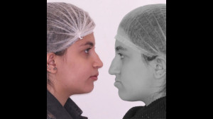 ارتودنسی و جراحی جلو بودن فک |...