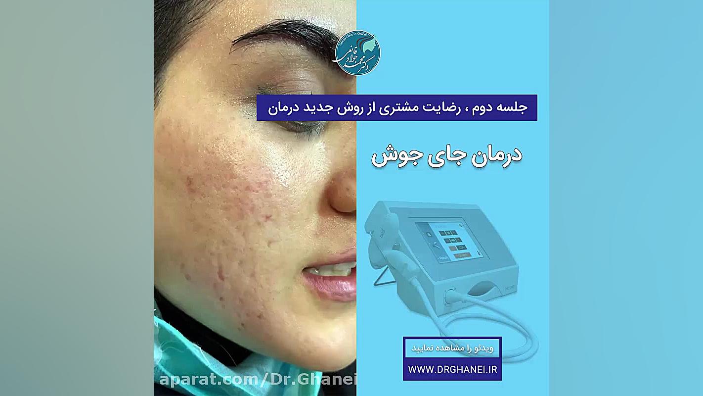 درمان جای جوش با دستگاه جدید ت...