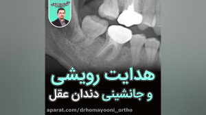 هدایت رویشی و جانشینی دندان عق...