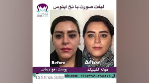 لیفت صورت با نخ آلمانی آپتوس م...
