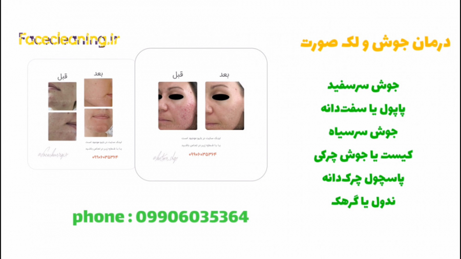 درمان خانگی جوش جای جوش صورت...