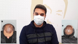 رضایت مراجعه کننده کاشت مو