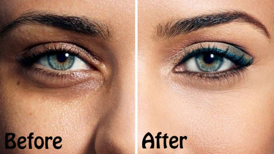 سیاهی و چروک های زیر چشم را از...