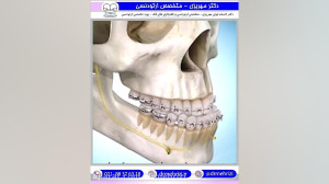 درمان ارتودنسی و جراحی جلو بود...