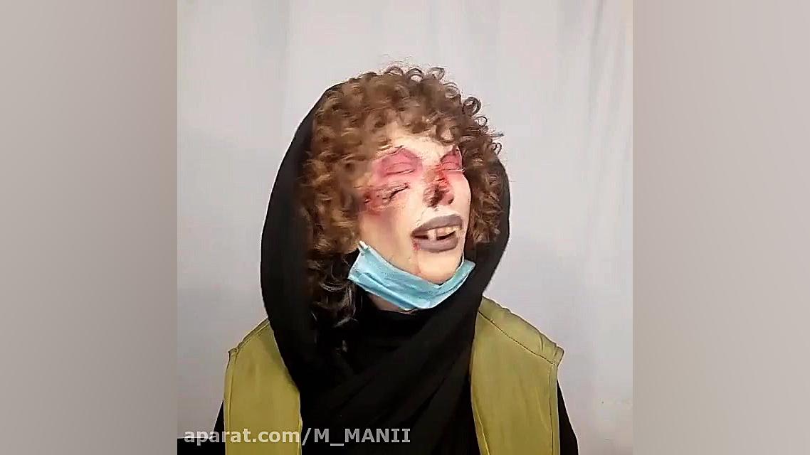 تزریق واکسن کرونا عوارض شدید.