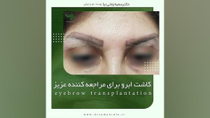 کاشت ابرو