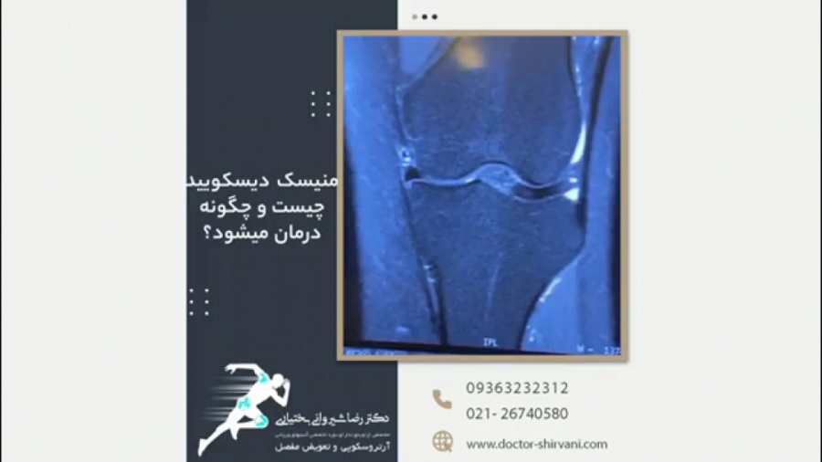 جراحی منیسک دیسکویید