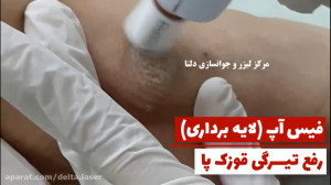 درمان تیرگی نواحی مختلف بدن