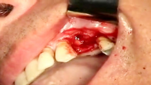 Dental Implant Process