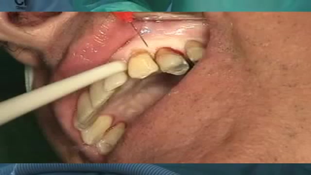 Dental Implant Process
