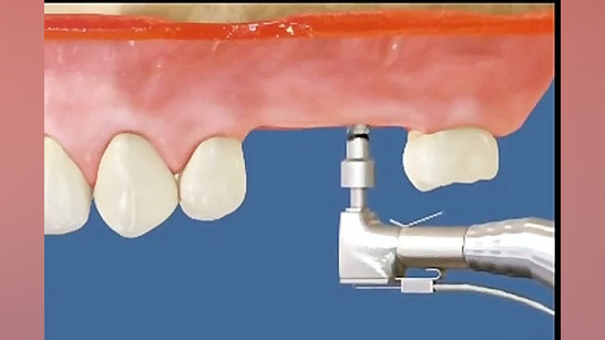 ایمپلنت دندان های عقب مرکز دند...