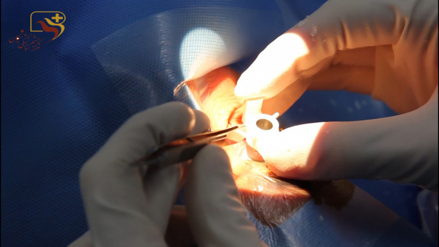 عمل پیوند قرنیه چشم