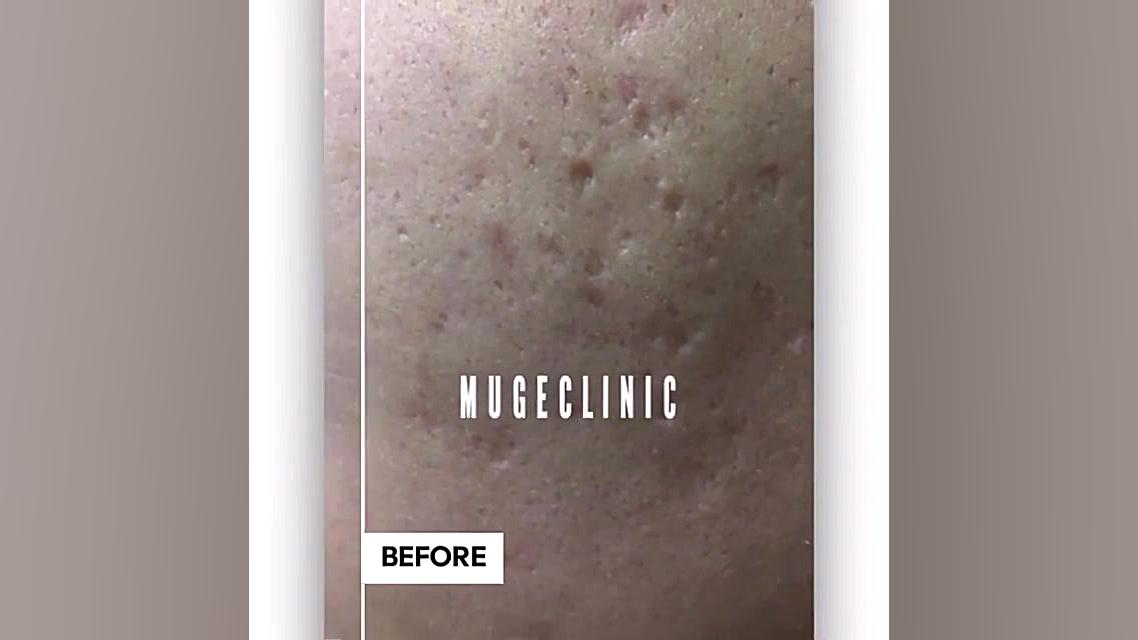 درمان ترکیبی جای جوش نتیجه دائ...