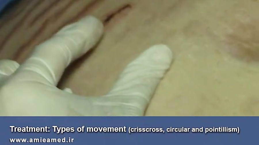 درمان استریا  ترک های پوستی به...