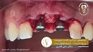فیلم واقعی ایمپلنت دندان جلو و...