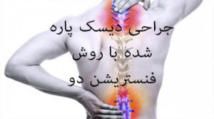 جراحی دیسک پاره شده با روش فنس...