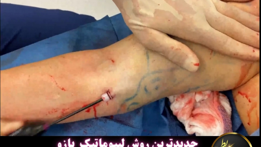 جراحی لاغری بازو