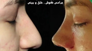 رینوپلاستی توسط دکتر امید ابرا...
