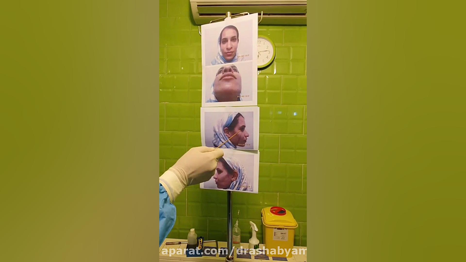 جراحی بینی کاملا گوشتی توسط دک...