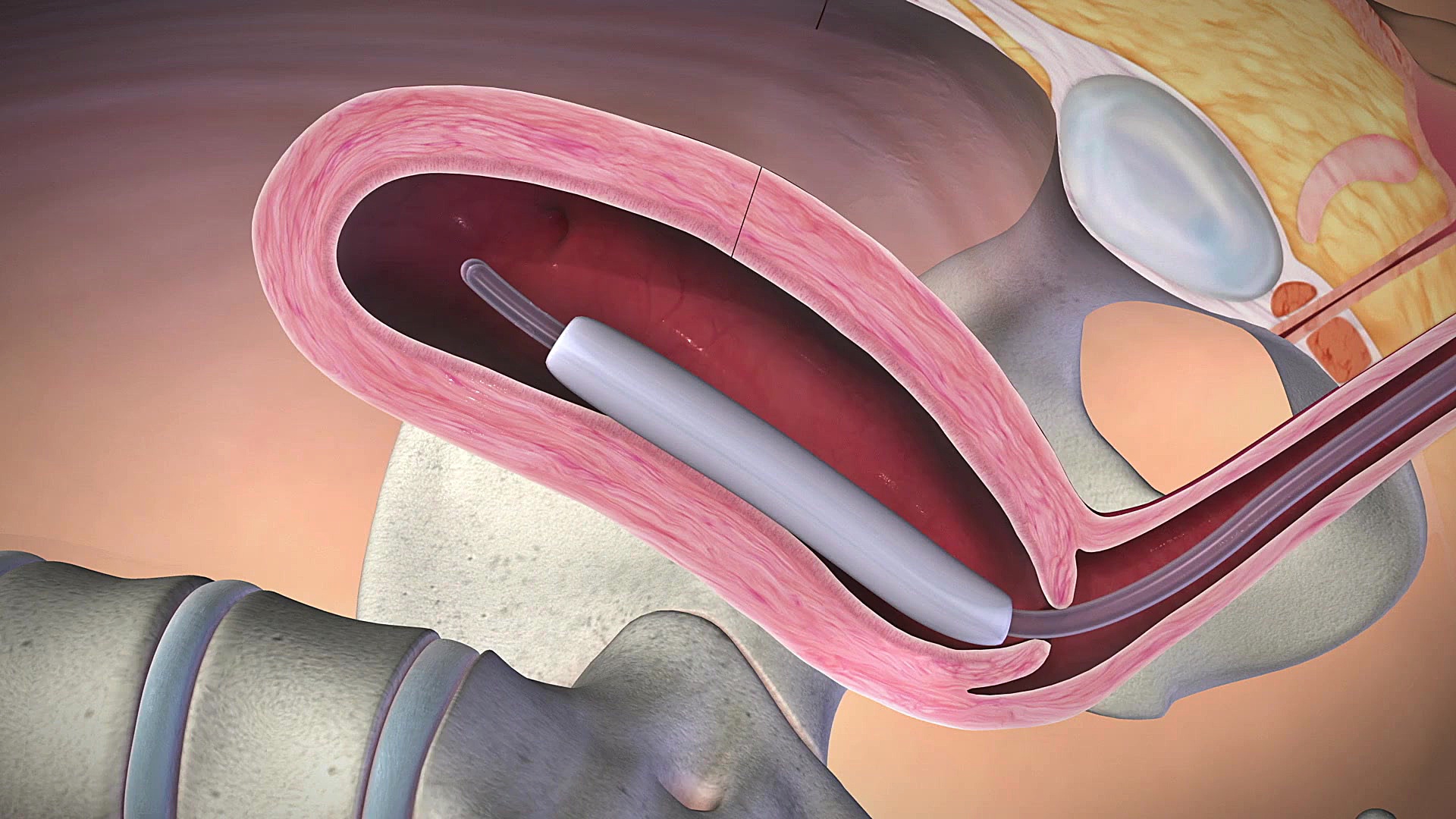 بالن بکری جهت خونریزی بعد از ز...