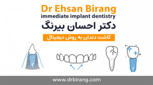 ایمپلنت دیجیتال تمام دهان یک ر...