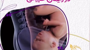 نحوه به دنیا آمدن نوزاد در زای...
