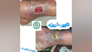 ترمیم زخم