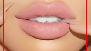 فرم دهی لبا با تزریق ژل