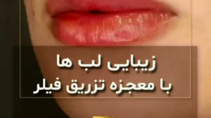 فیلم معجزه تزریق ژل لب