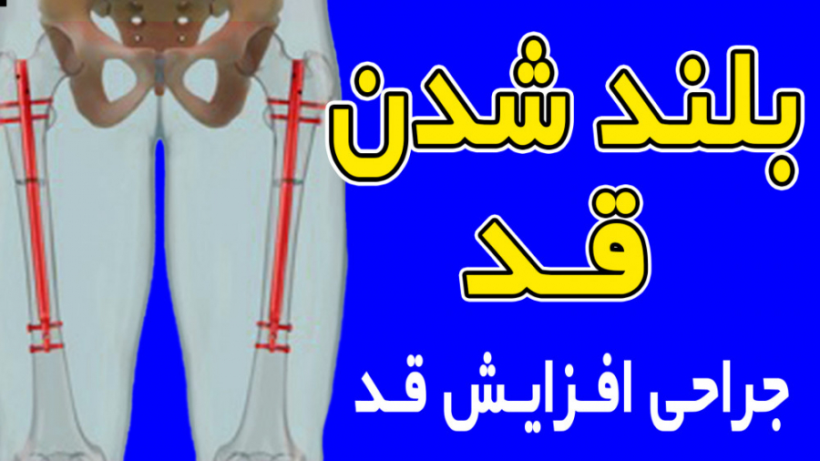 عمل جراحی افزایش قد | مکانیزم...