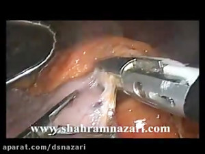 اسلیو گاسترکتومی (اسلیو معده)