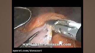 اسلیو گاسترکتومی (اسلیو معده)