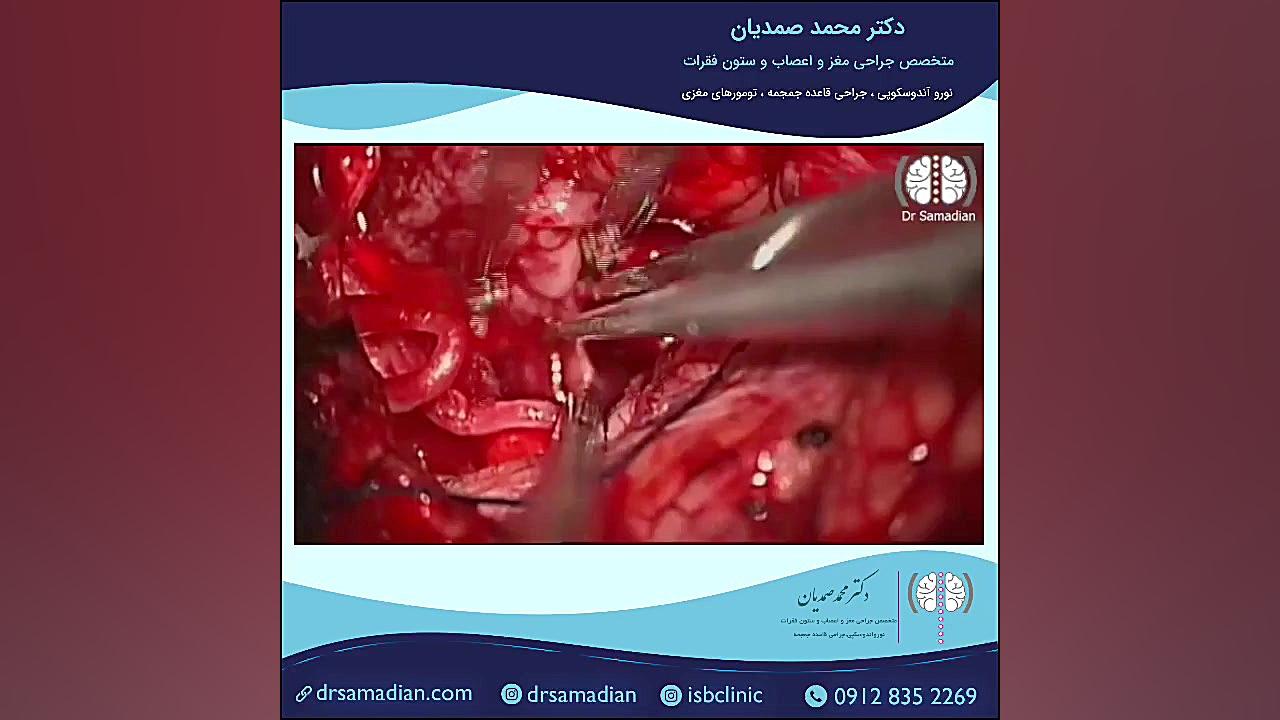 جراحی تومور ساقه مغز