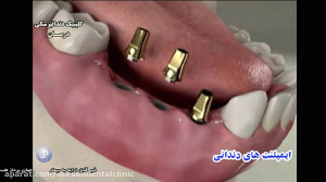 ایمپلنت های دندانی