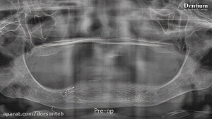 Implant Supported Overdenture