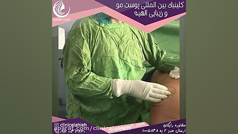 عمل باسن های جراحی شده