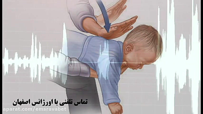 باز کردن راه هوایی کودک با راه...