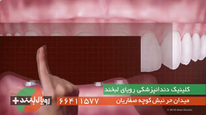 ایمپلنت دندانی، دندانی برای هم...