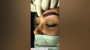 کاشت ابرو پهن