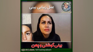 55 روز بعد از عمل زیبایی بینی...